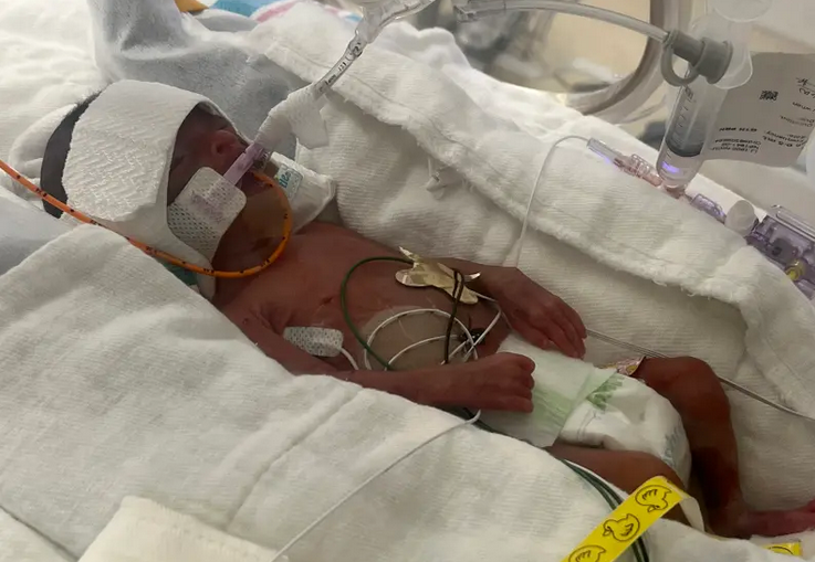 Baby Born at 24 Weeks, Size of a Barbie Doll, Heads Home From Hospital