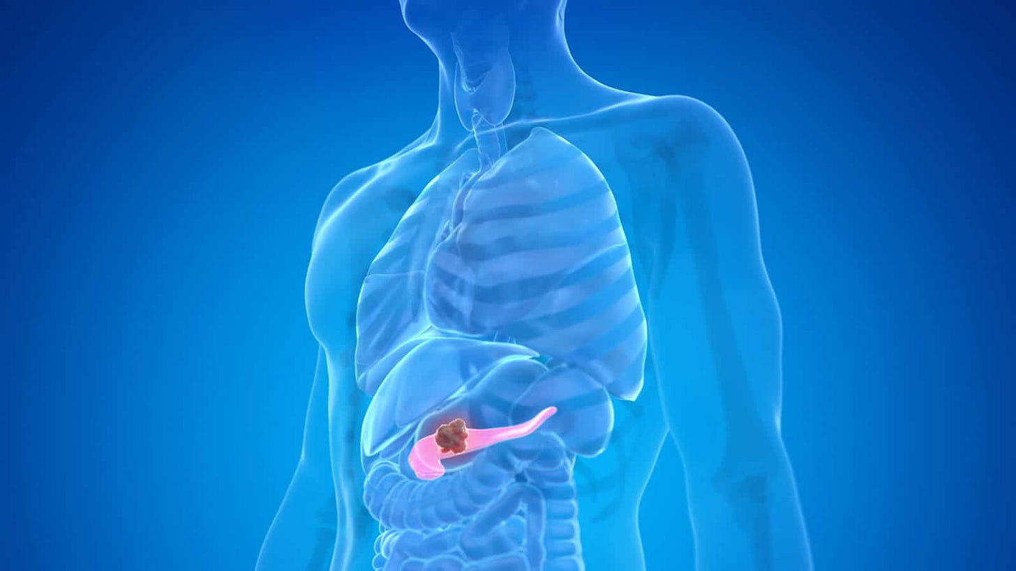 The 10 Deadliest Cancers—and How to Stop Them